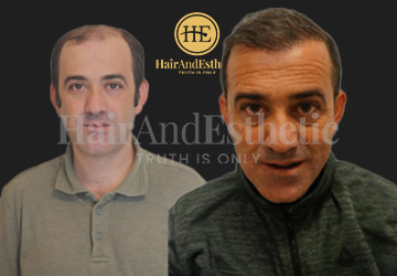 hair-transplant-before-after