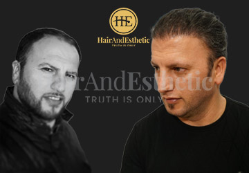 hair-transplantation-before-after