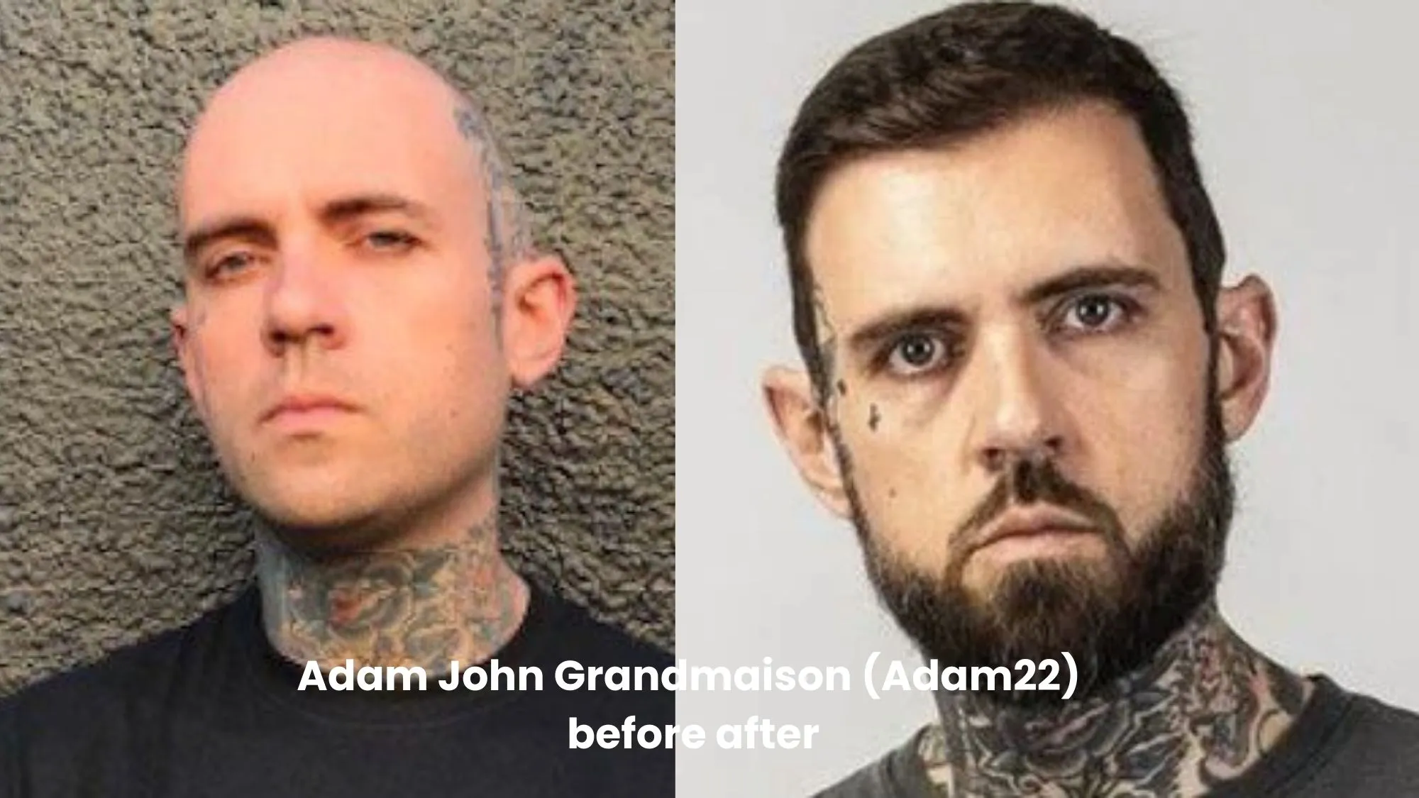 Adam John Grandmaison (Adam22) hair transplant