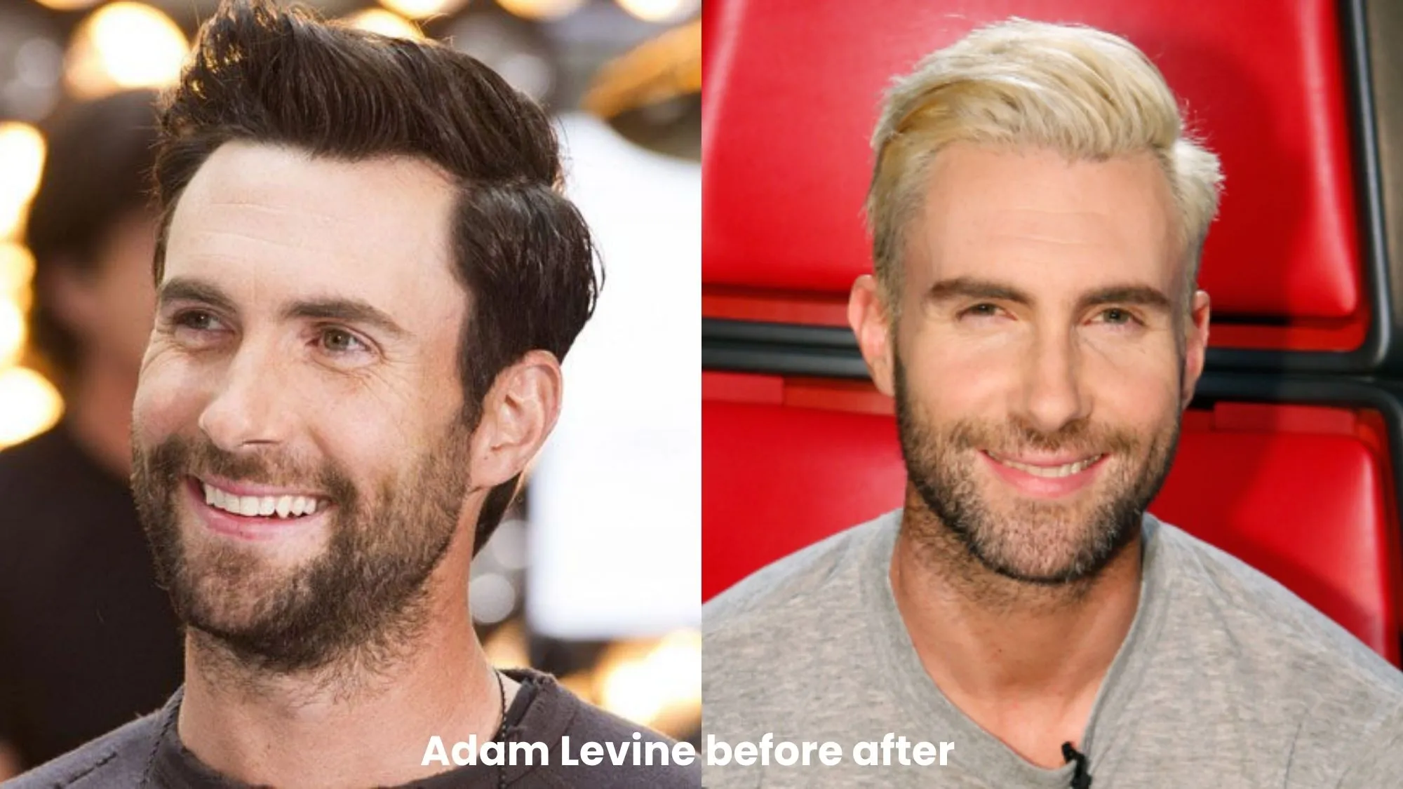 Adam Levine hair transplant