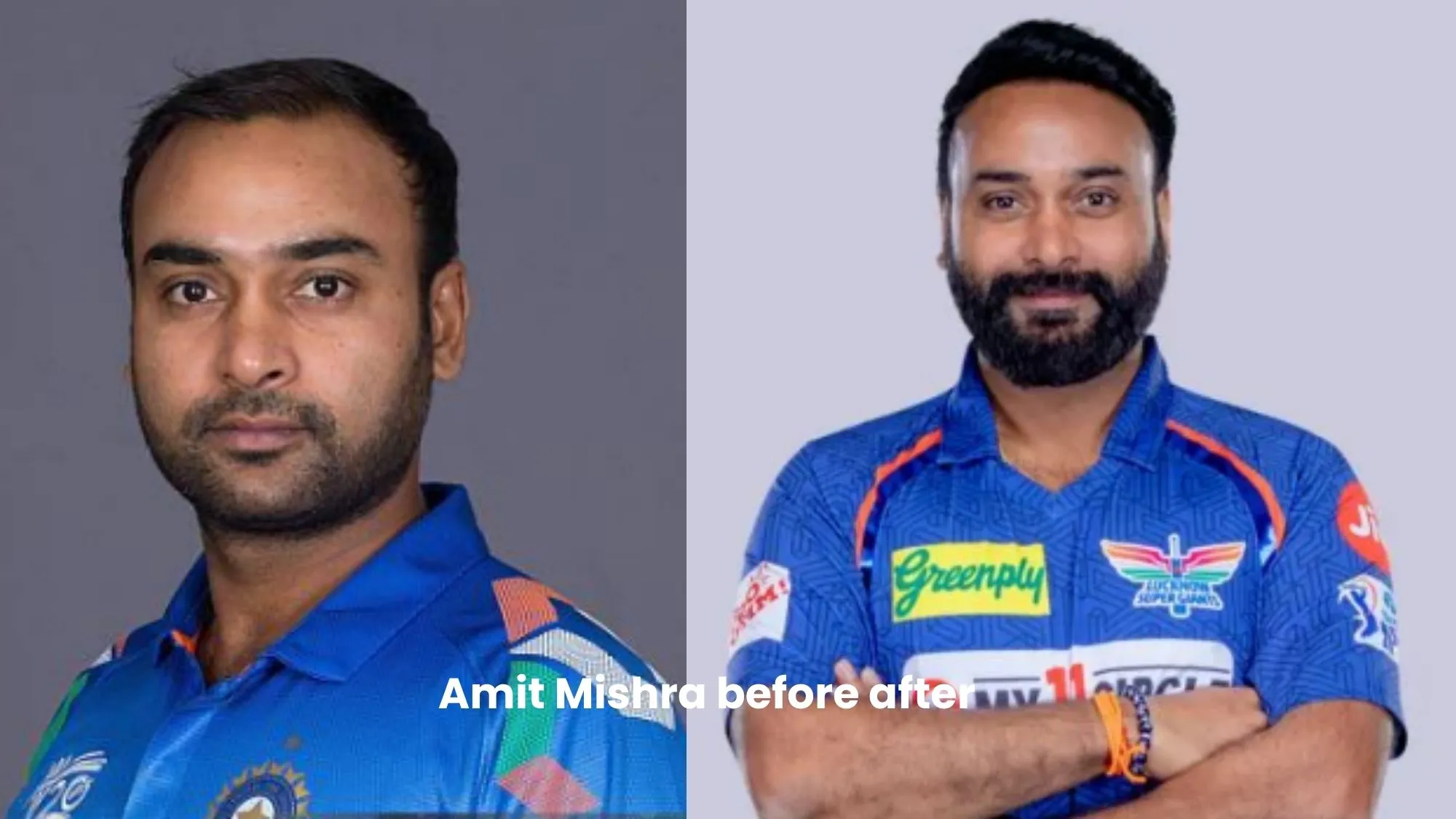 Amit Mishra hair transplant