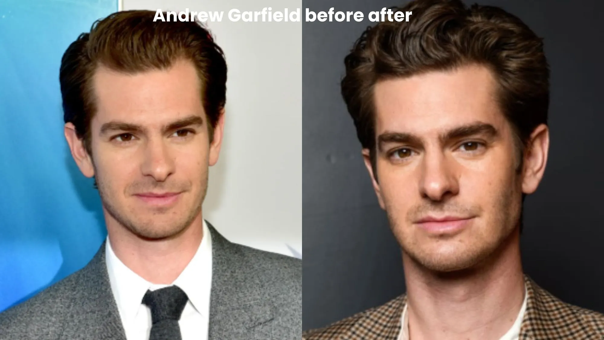 Andrew Garfield hair transplant