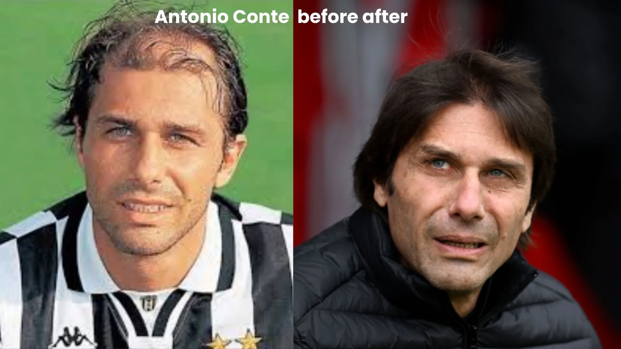 Antonio Conte hair transplant