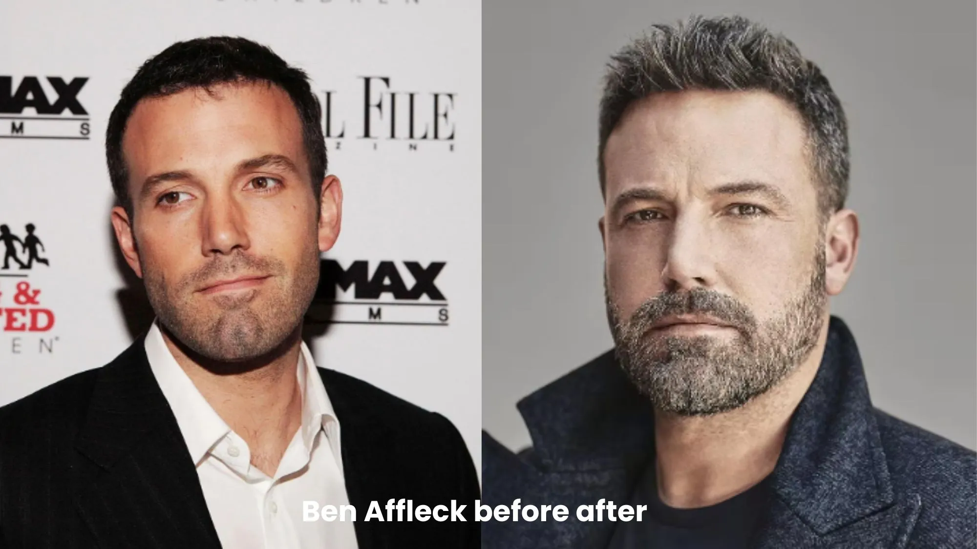 Ben Affleck hair transplant