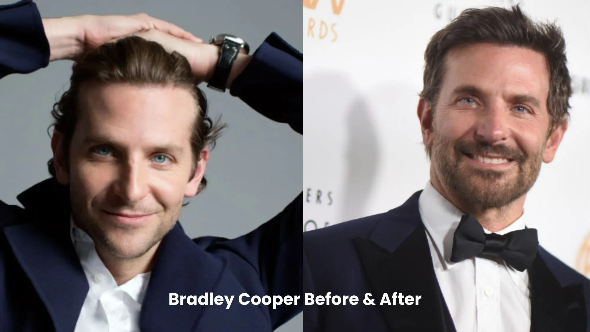 Bradley Cooper hair transplant