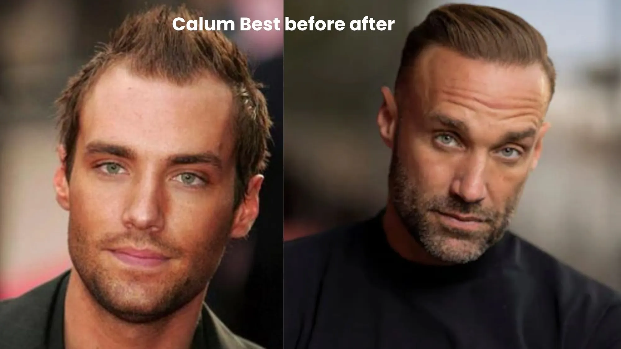 Calum Best hair transplant