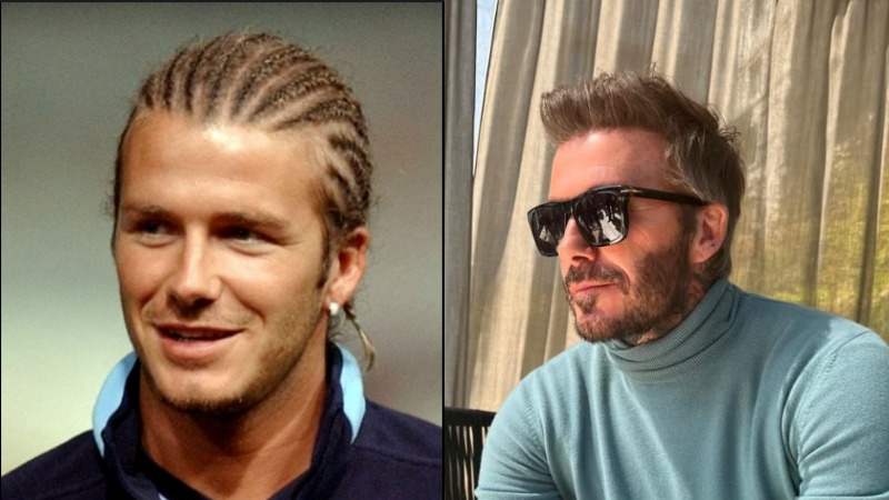 Celebrities hair transplant