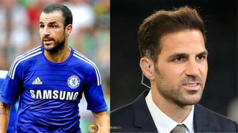 Cesc Fabregas hair transplant