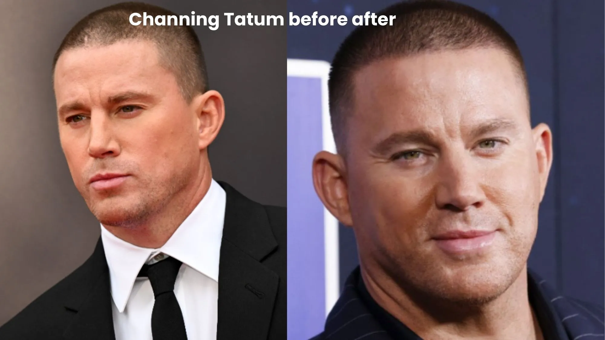 Channing Tatum hair transplant