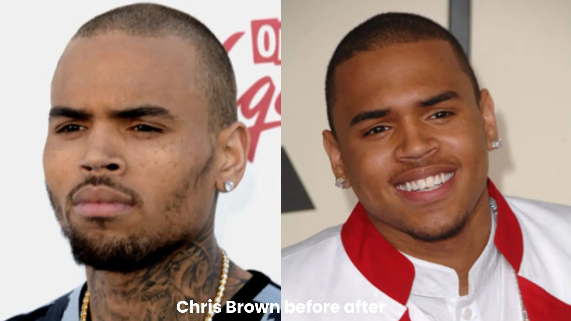 Chris Brown hair transplant