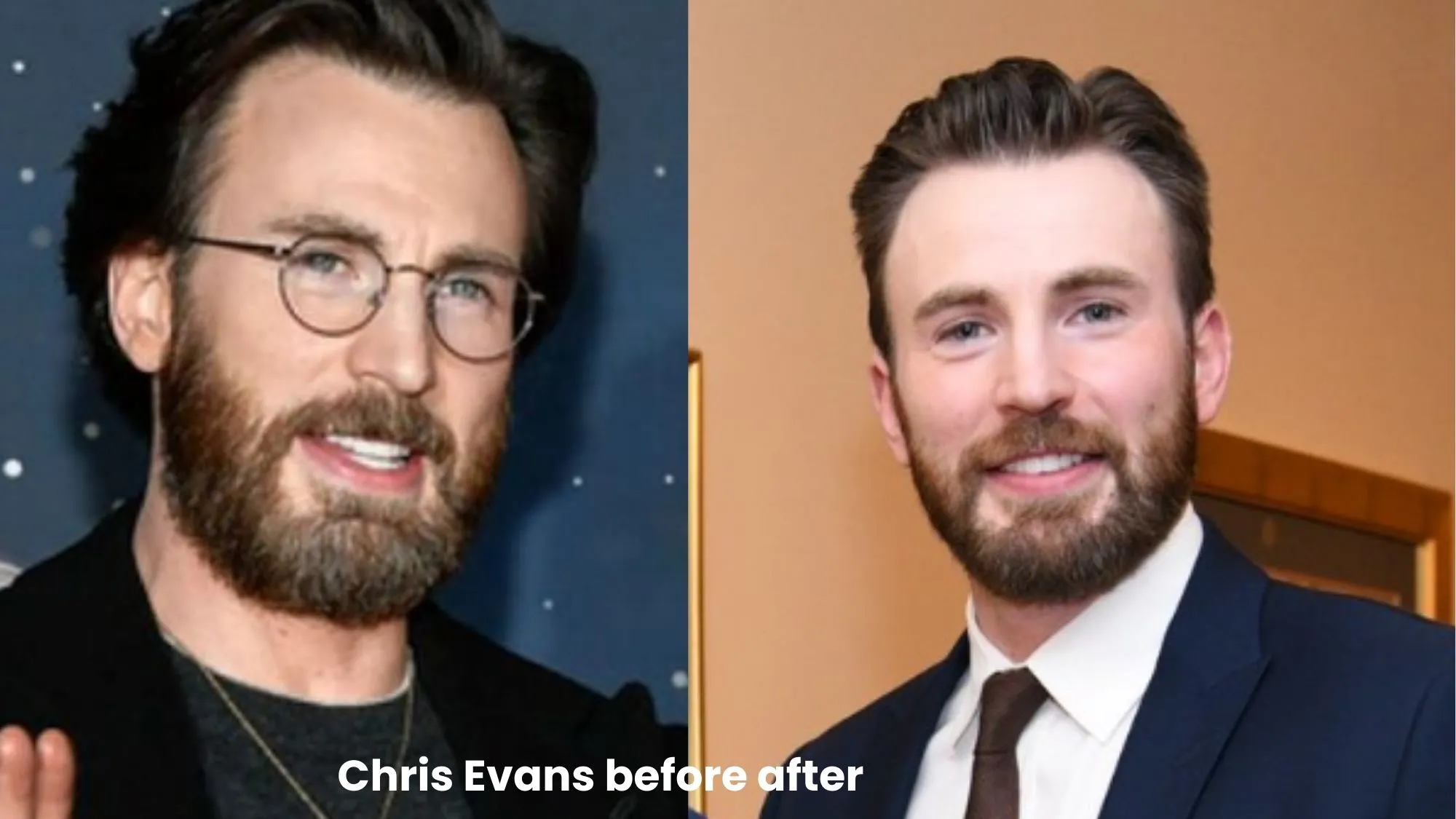 Chris Evans  hair transplant