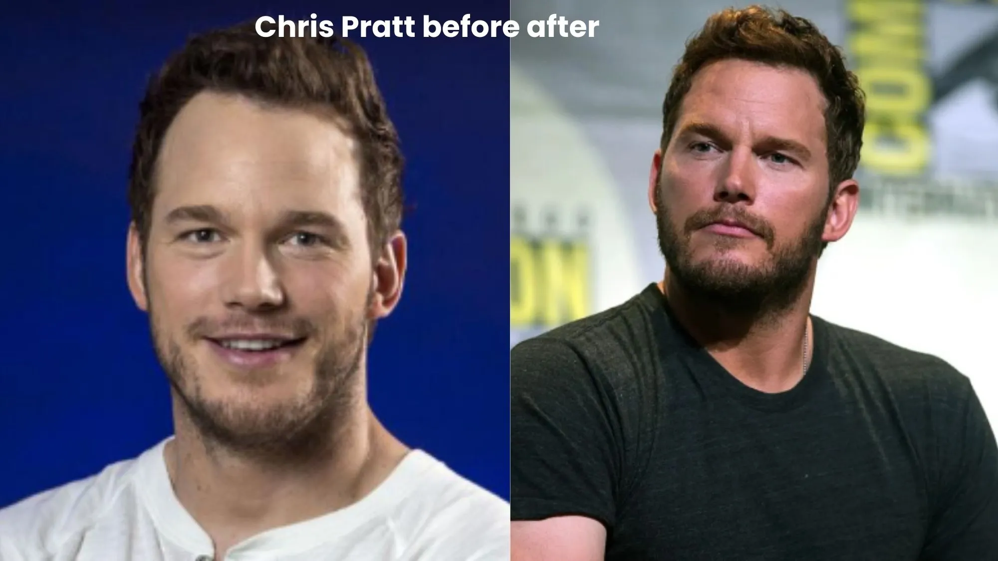 Chris Pratt hair transplant