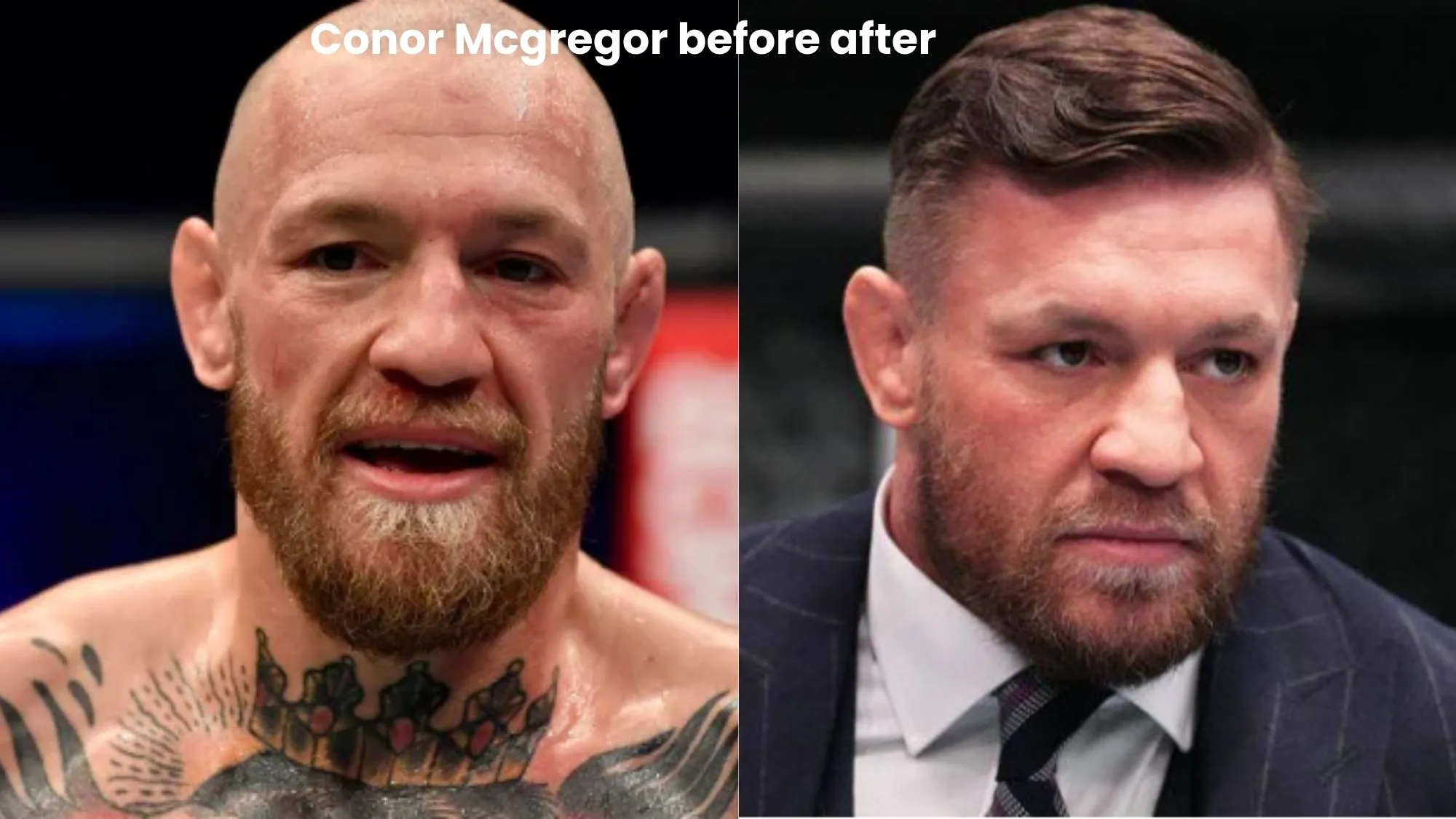 Conor Mcgregor hair transplant