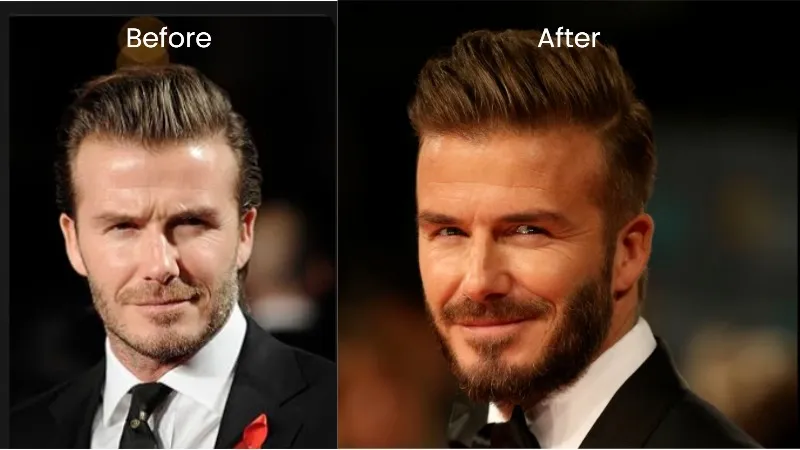 Hair transplant before after