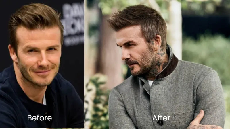 David Beckham hair transplant