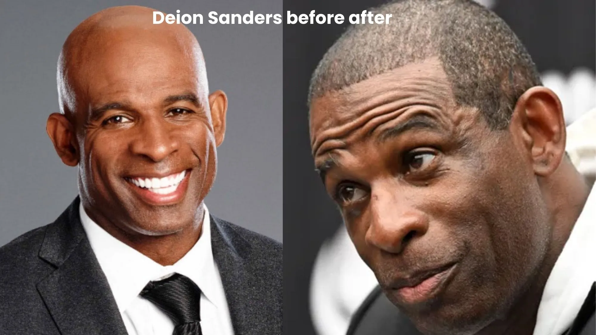 Deion Sanders hair transplant