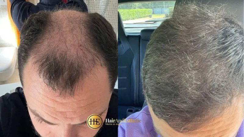 Baldness Treatment Turkey