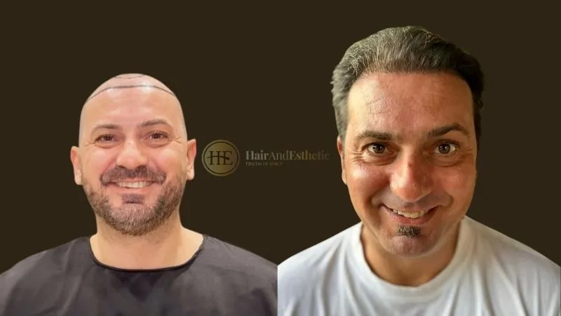 DHI hair transplant lifetime