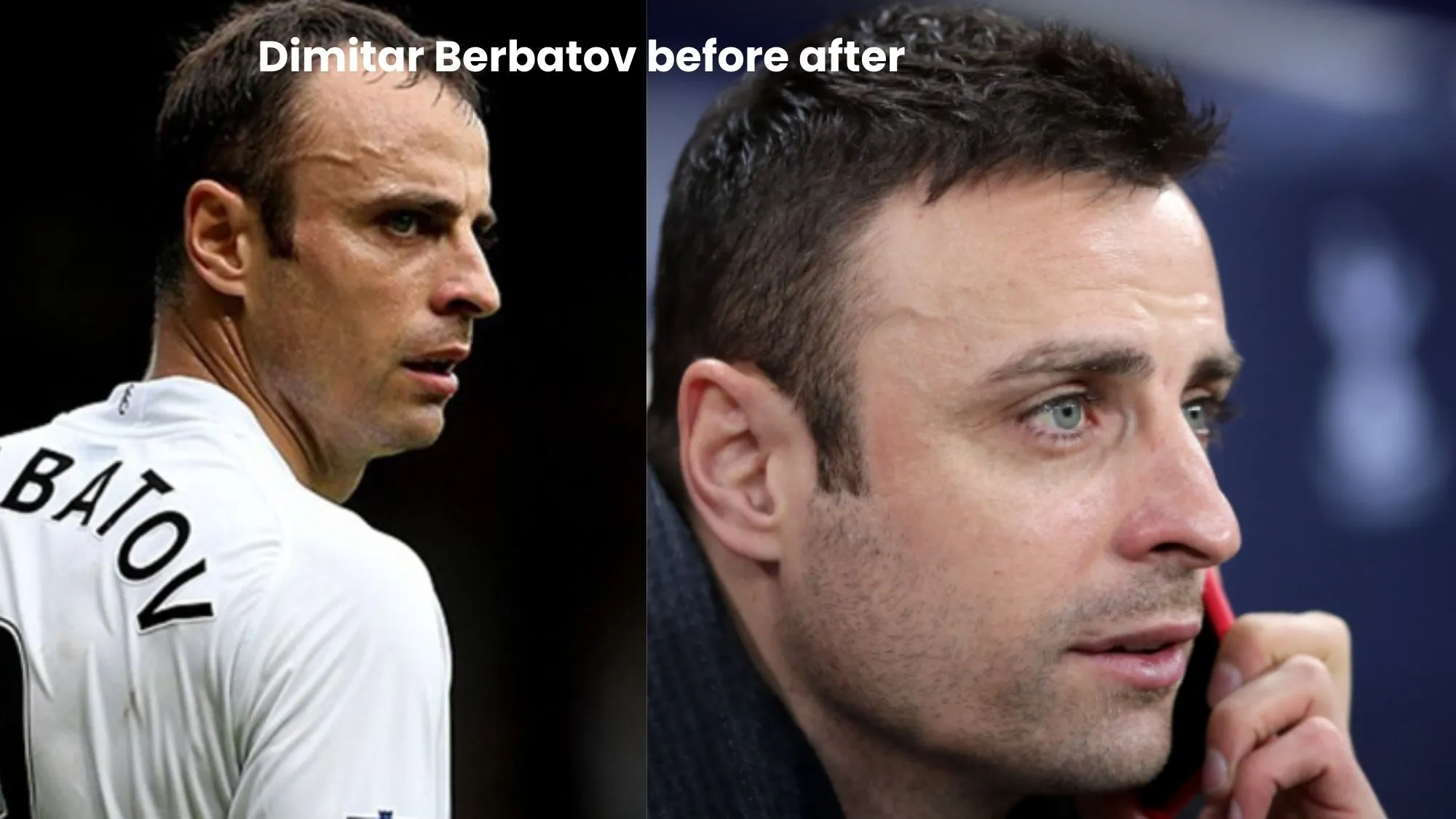 Dimitar Berbatov hair transplant