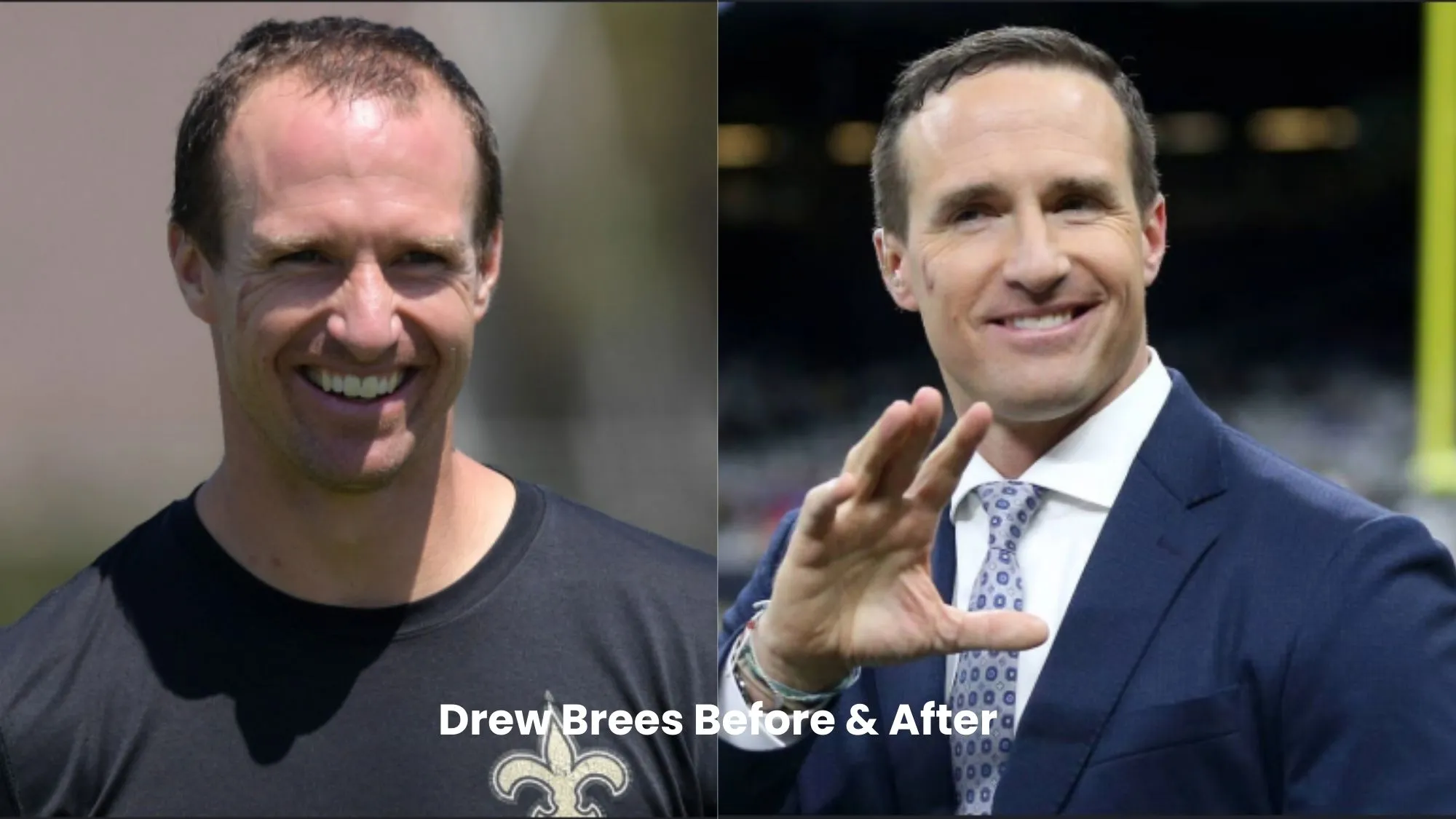 Drew Brees hair transplant