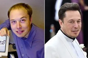 elon-musk-hair-transplant