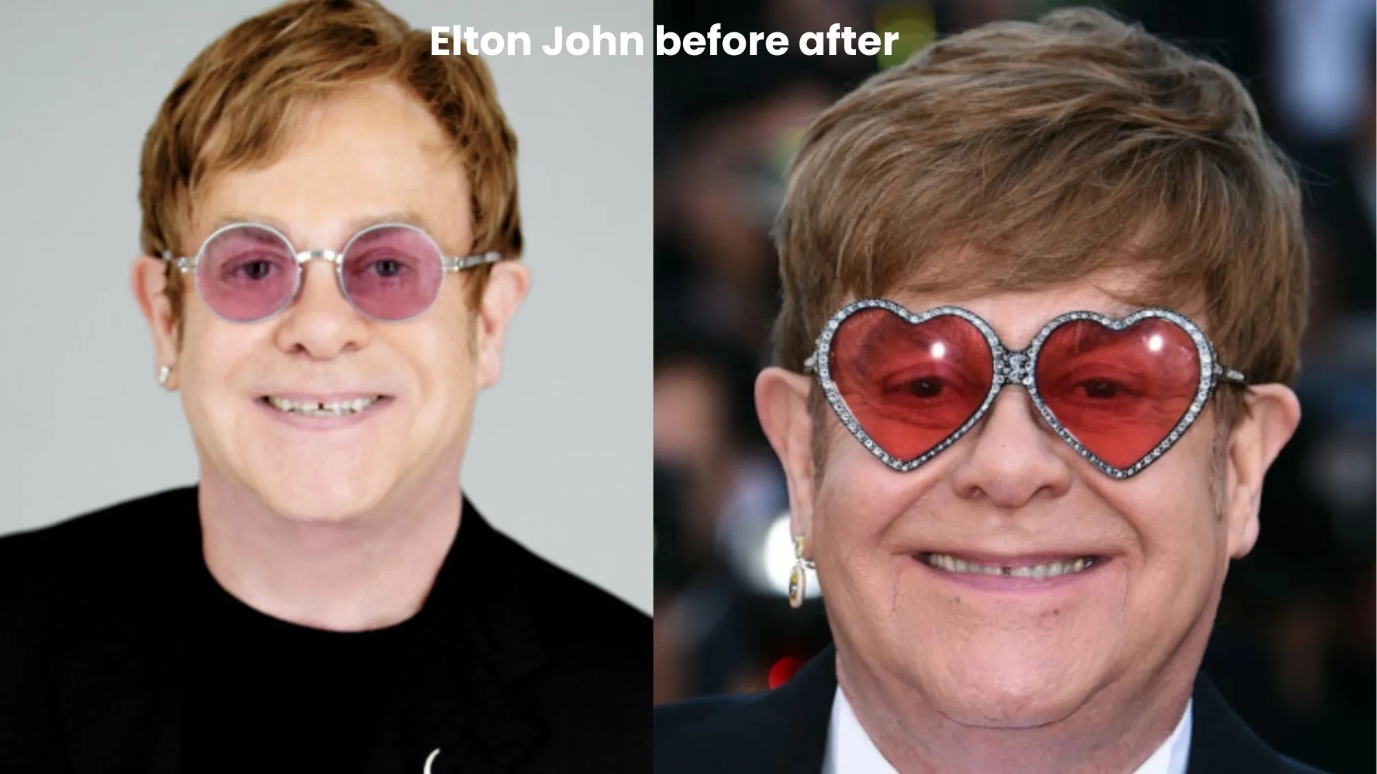 Elton John hair transplant