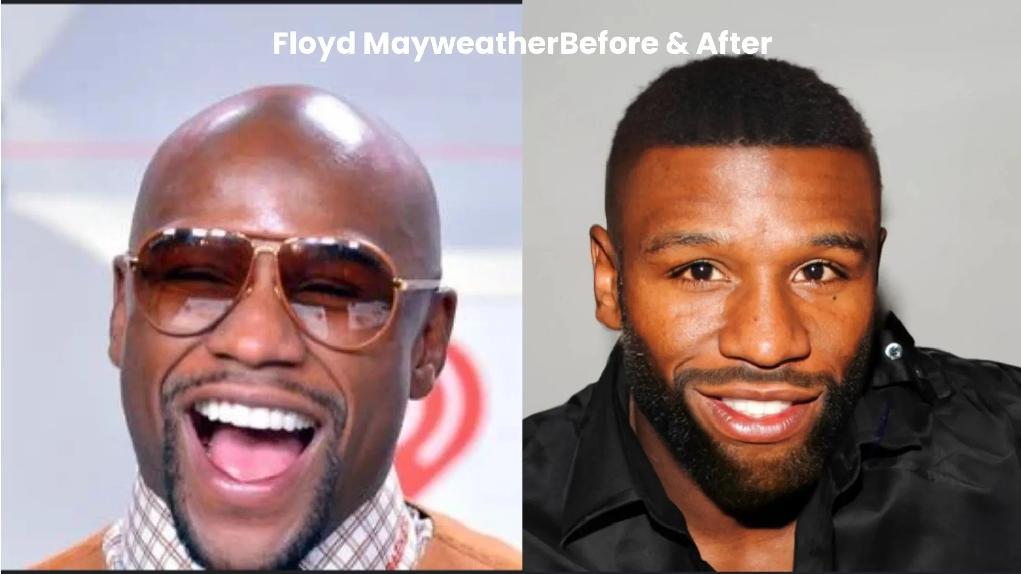 Floyd Mayweather hair transplant