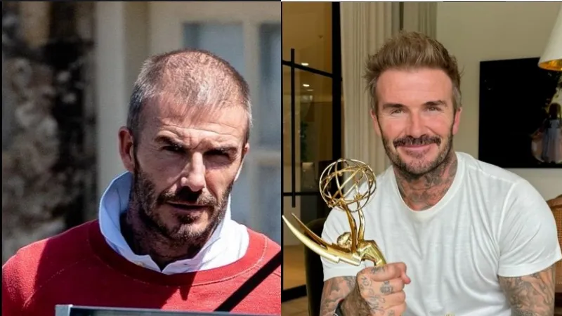 David Beckham hair transplant