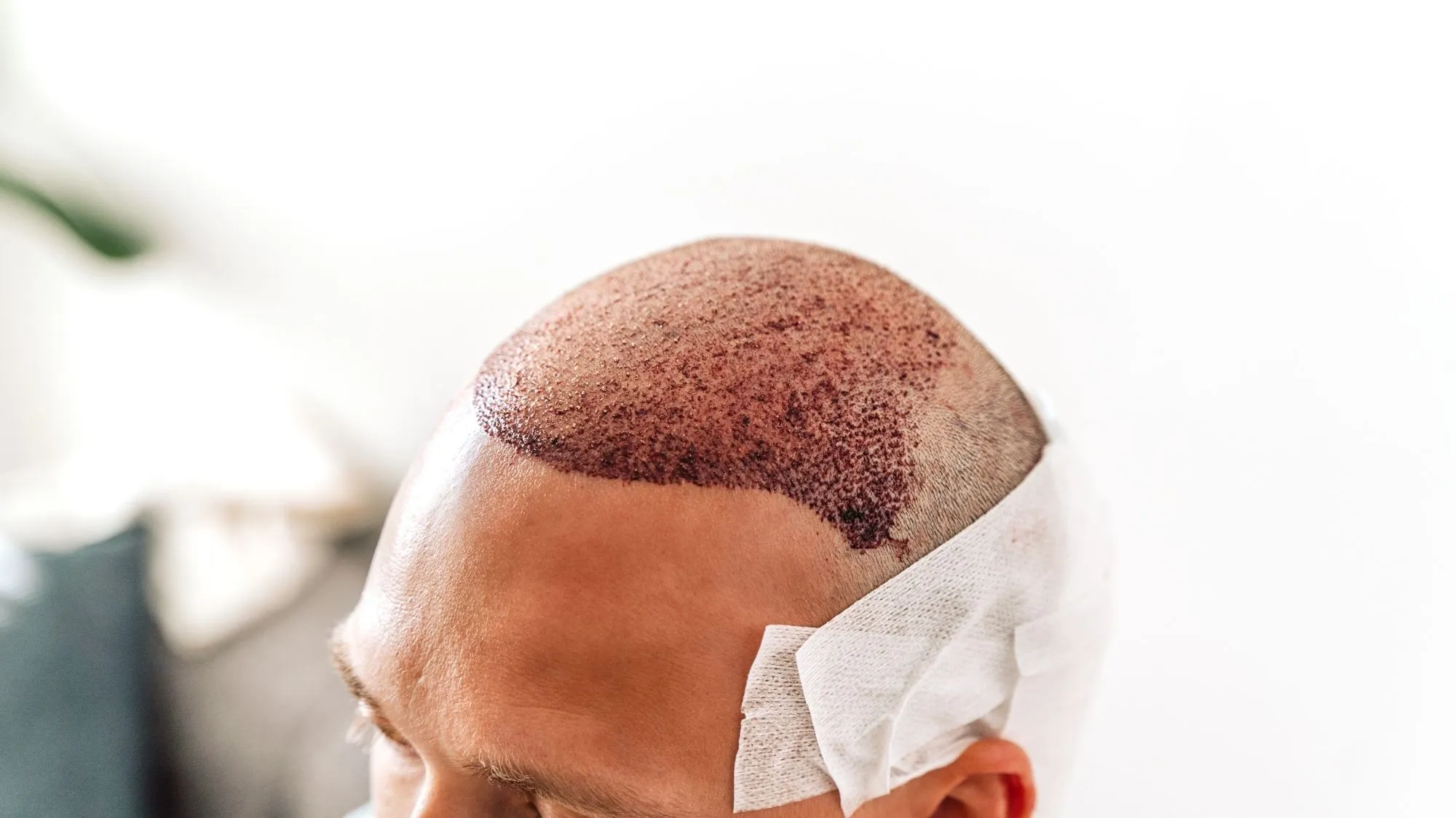 FUE hair transplant vs. FUT hair transplant