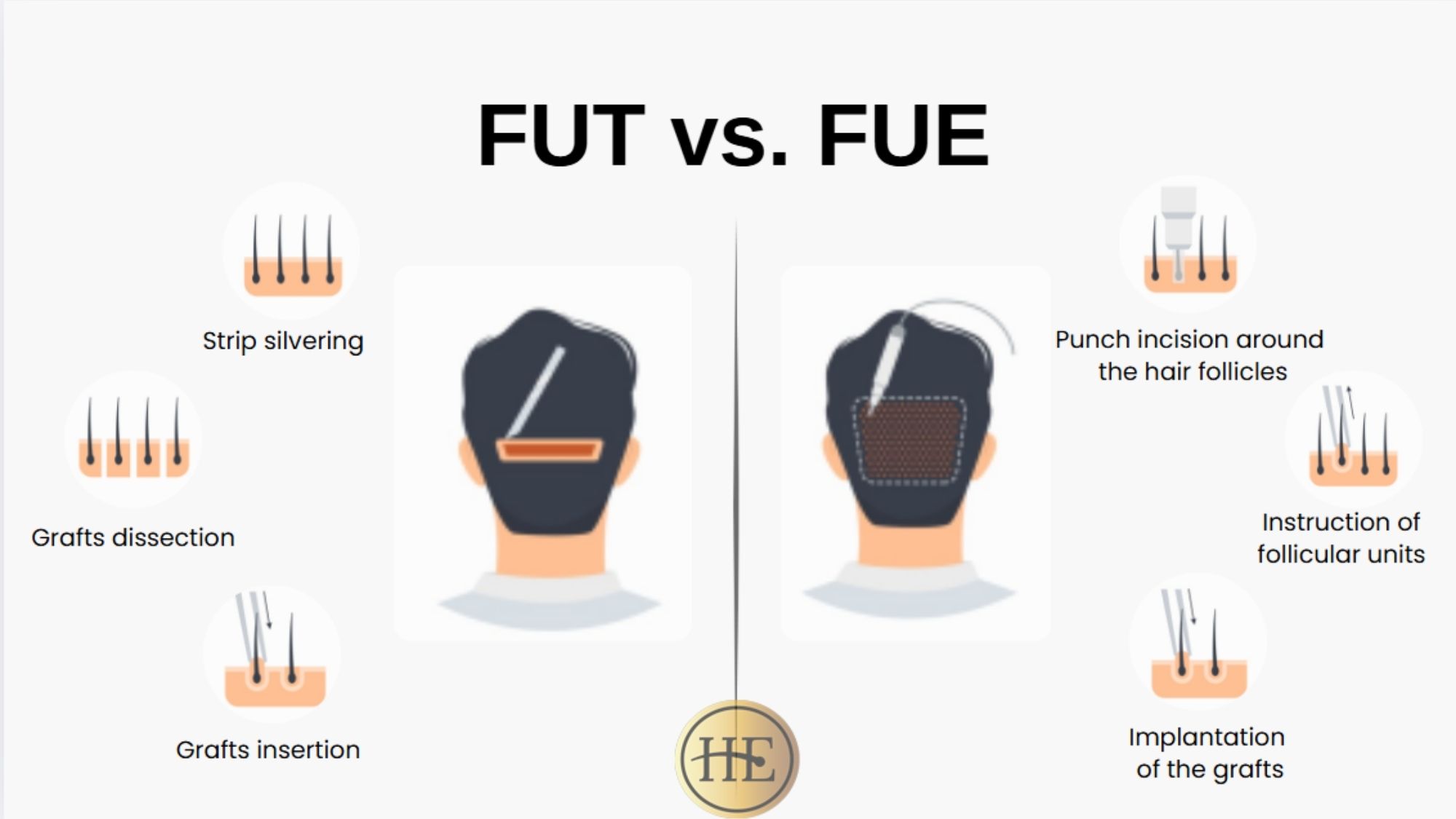 FUE hair transplant vs. FUT hair transplant