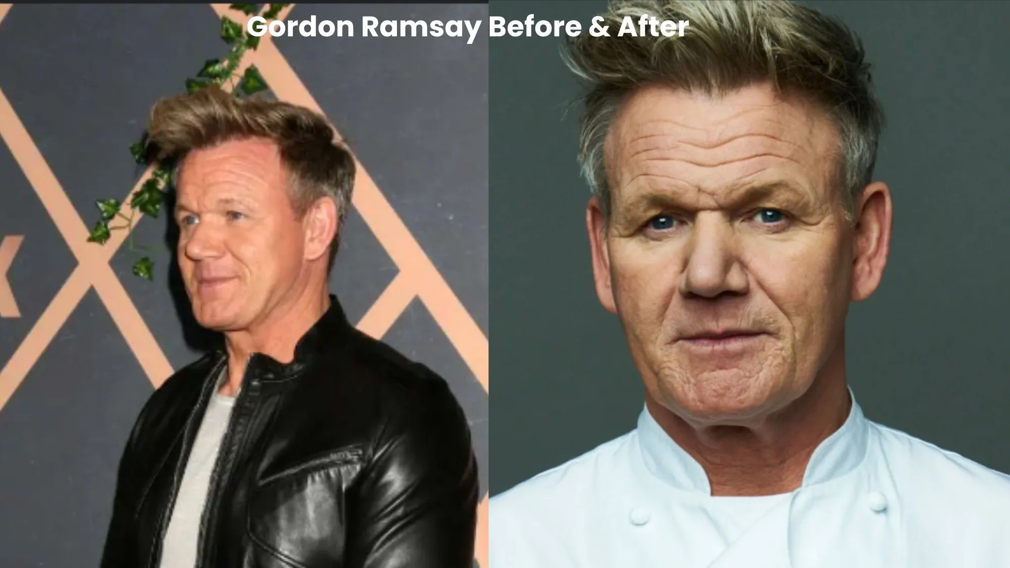 Gordon Ramsay hair transplant