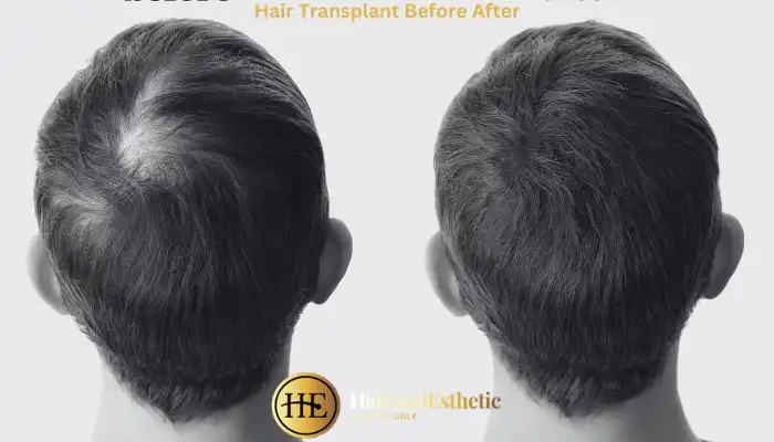 Hair Transplantation before after