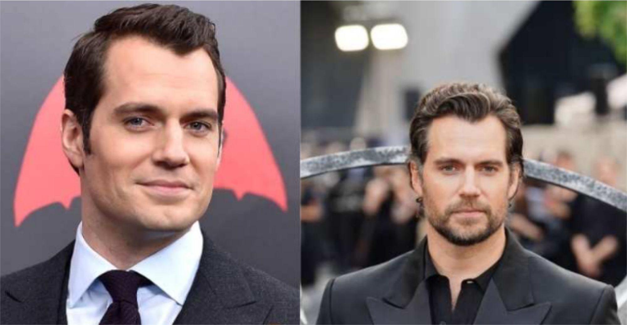 henry-cavill-hair-transplant