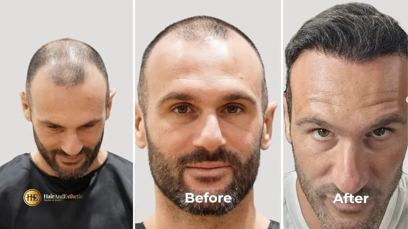 FUE Hair Transplants FUE Hair Transplants in Istanbul