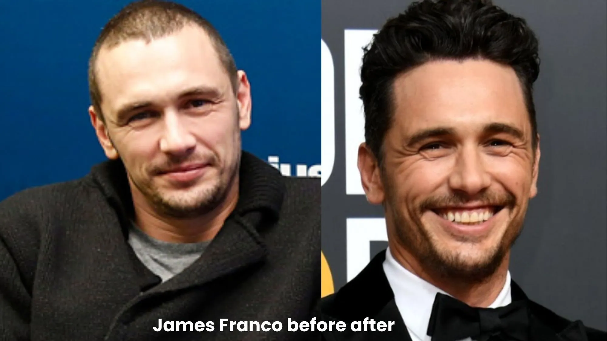 James Franco hair transplant