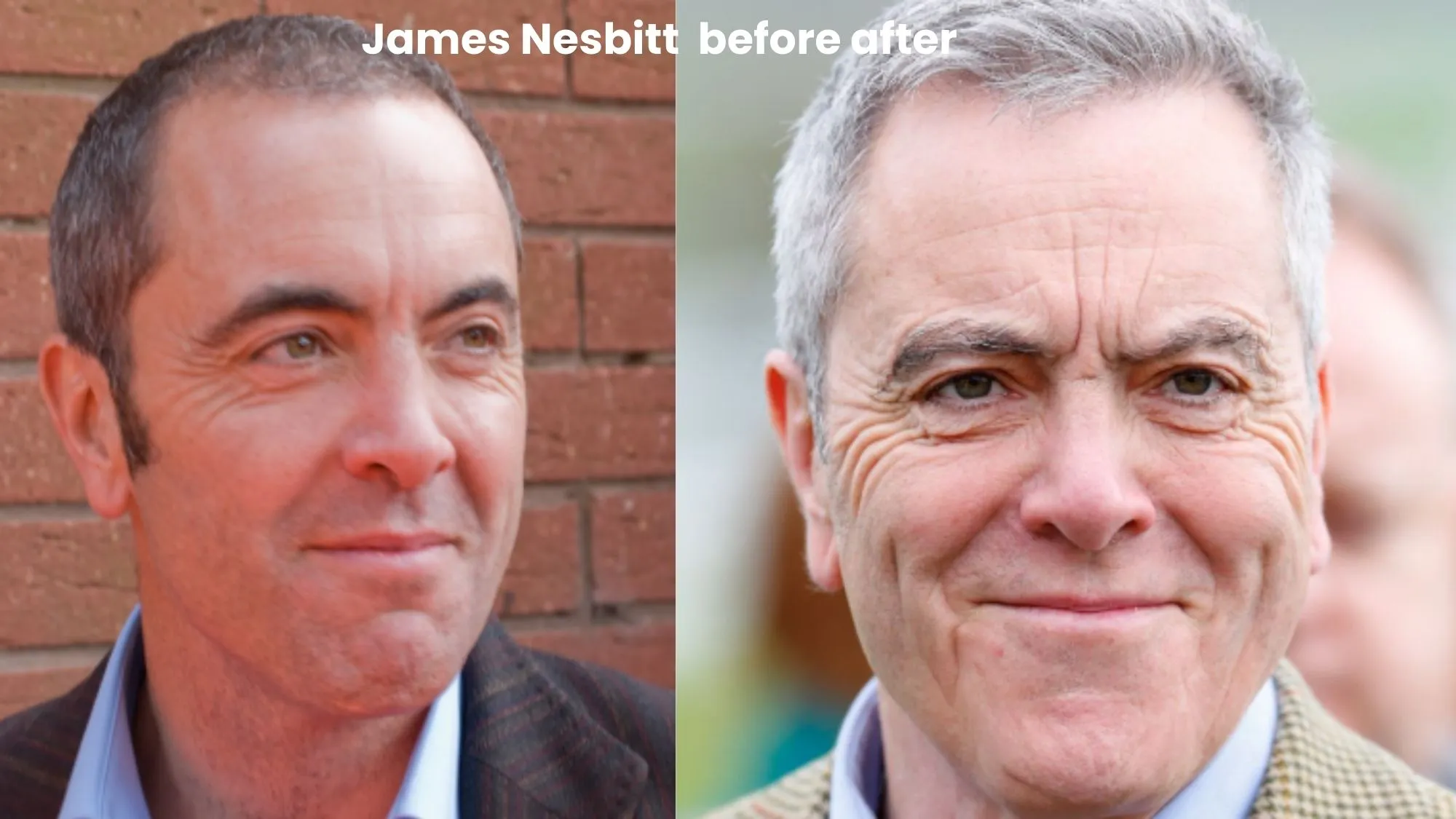 James Nesbitt hair transplant