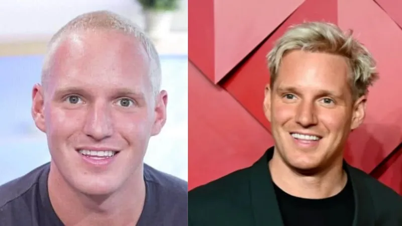 Jamie Laing hair transplant