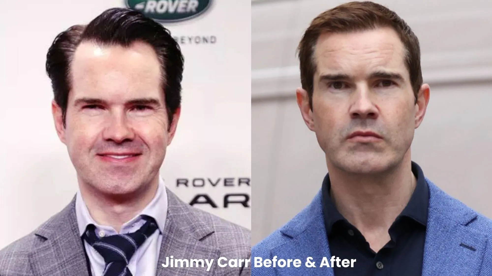 Jimmy Carr hair transplant