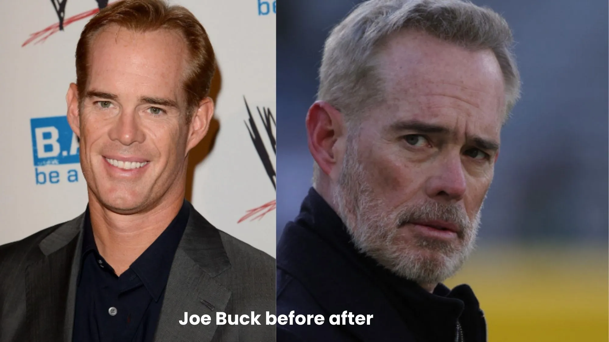 Joe Buck hair transplant