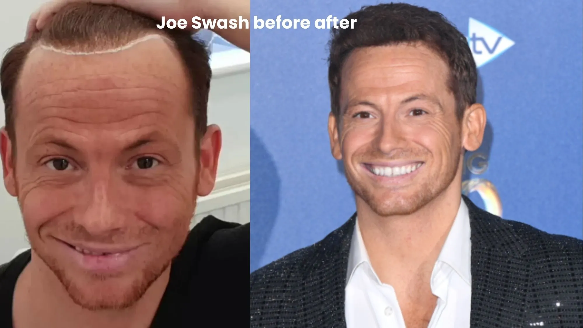 Joe Swash hair transplant