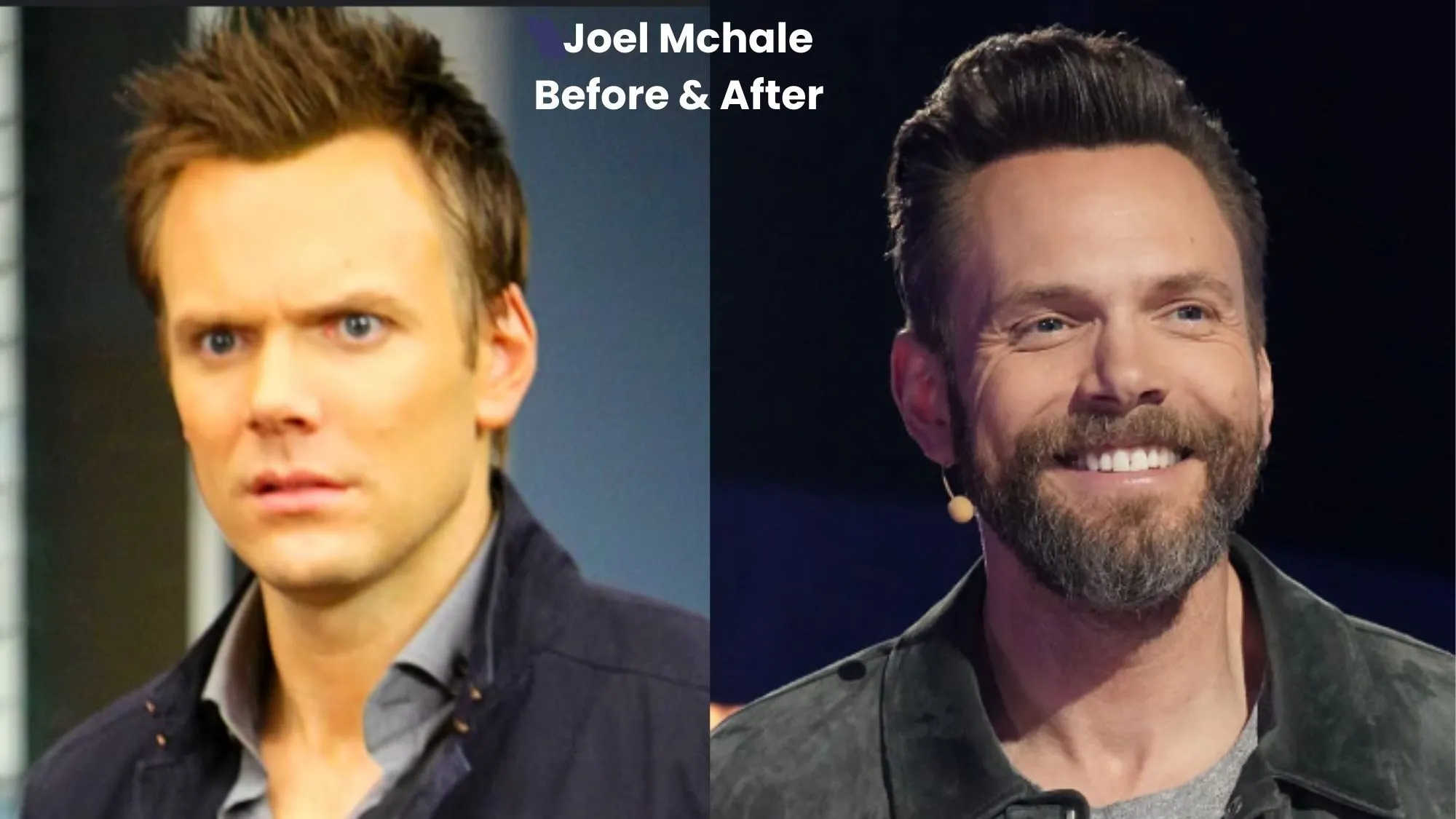 Joel Mchale hair transplant