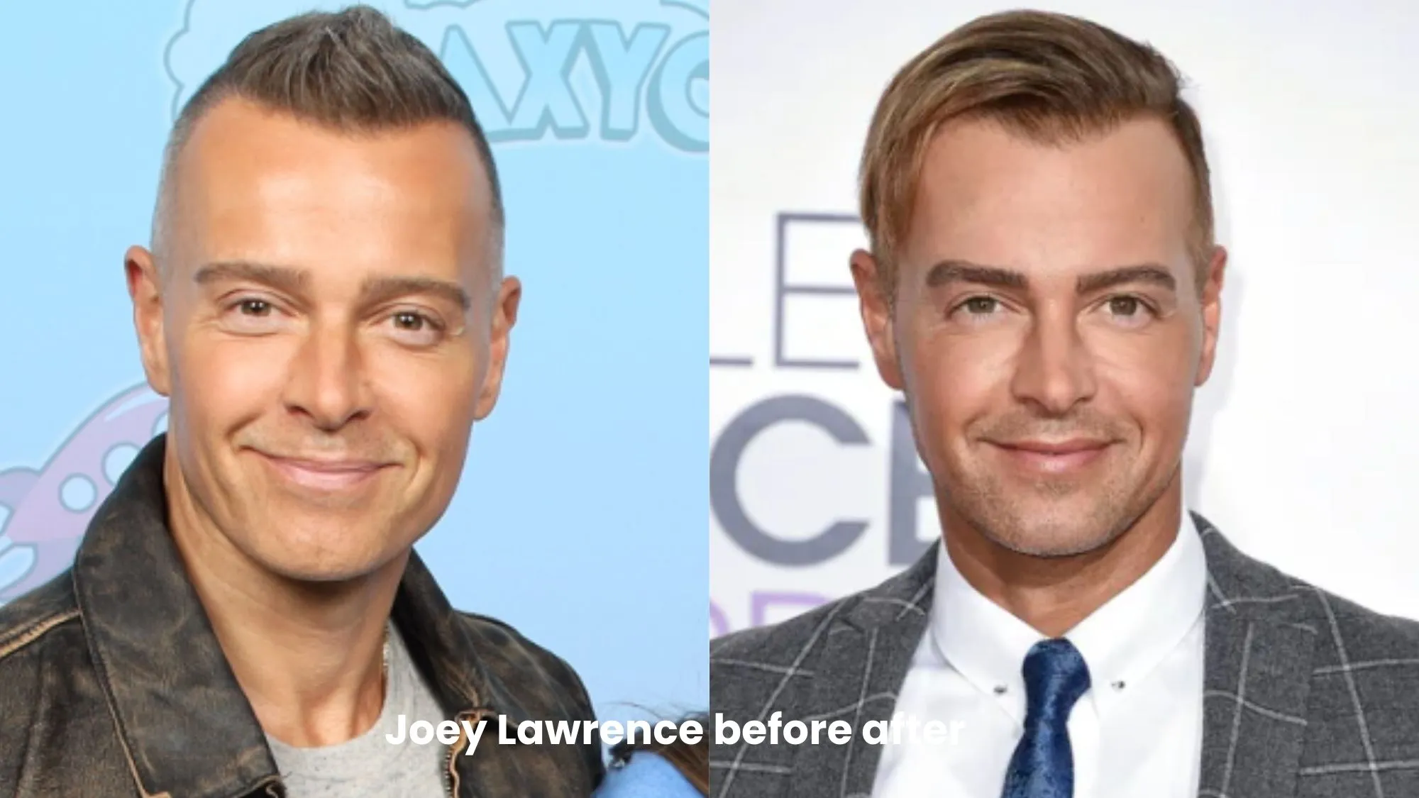 Joey Lawrence hair transplant