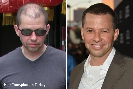 john-cryer-hair-transplant-turkey
