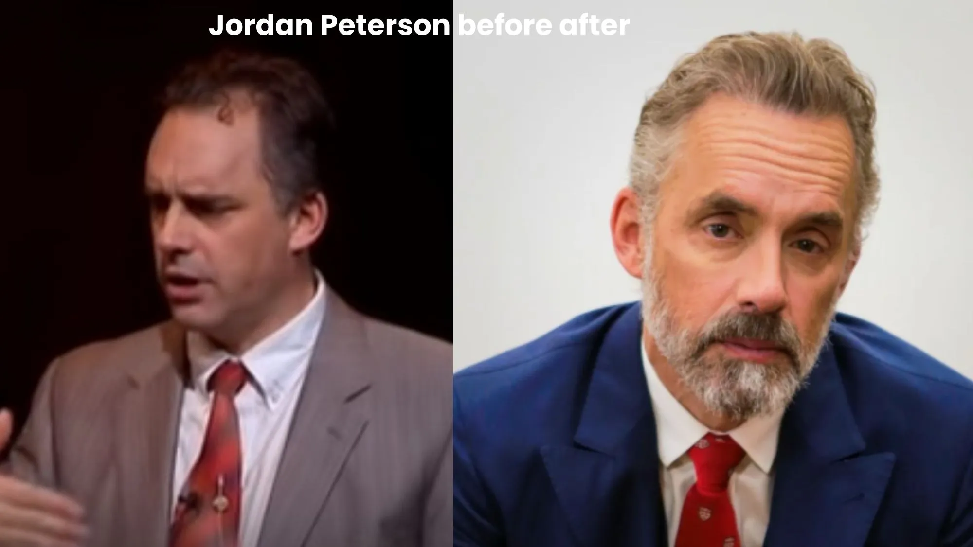 Jordan Peterson hair transplant