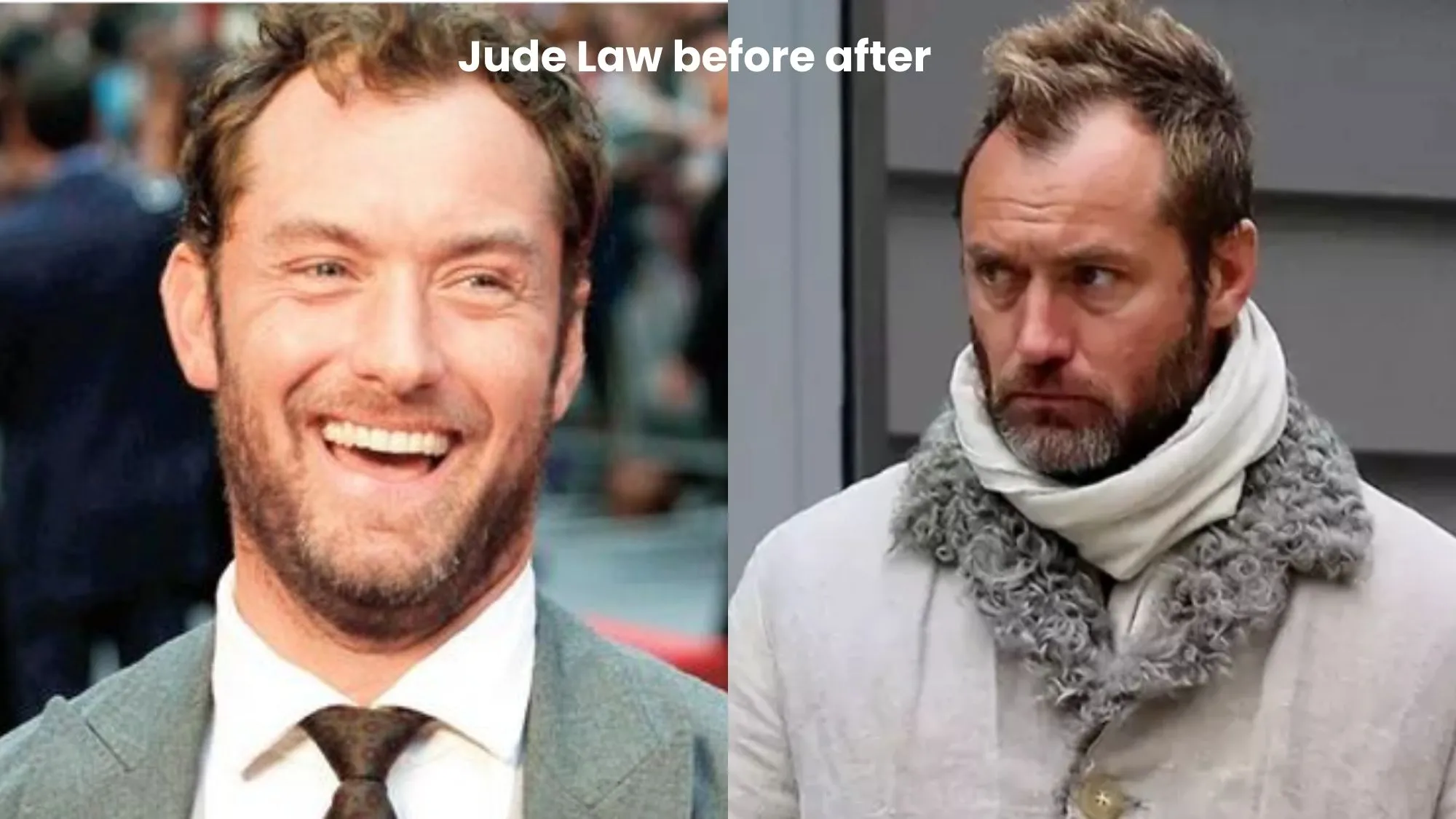 Jude Law hair transplant