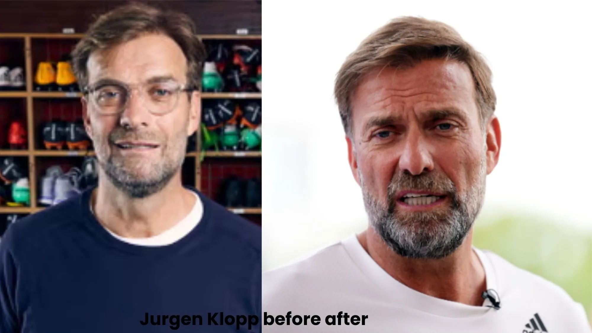 Jurgen Klopp hair transplant