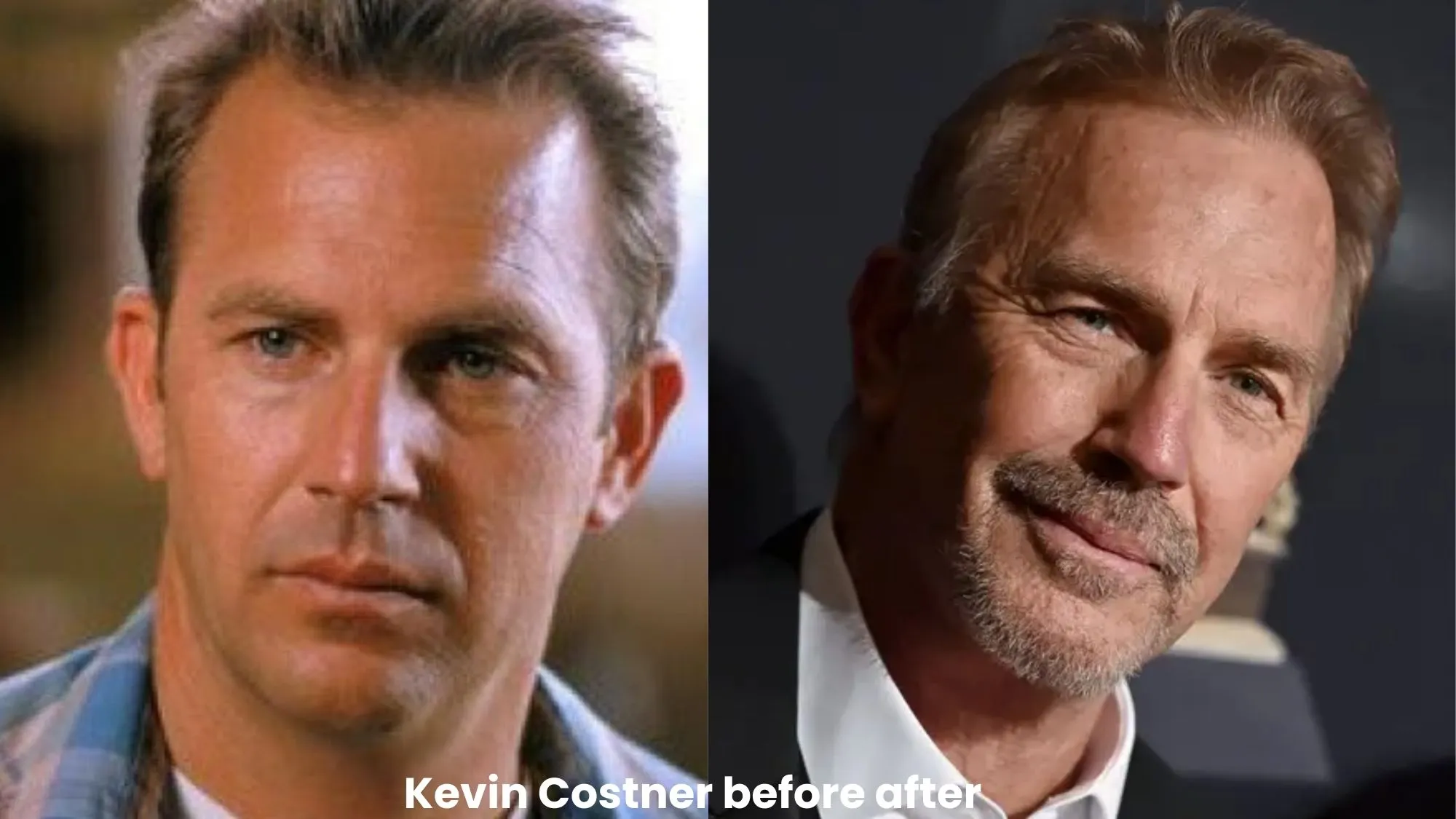 Kevin Costner hair transplant