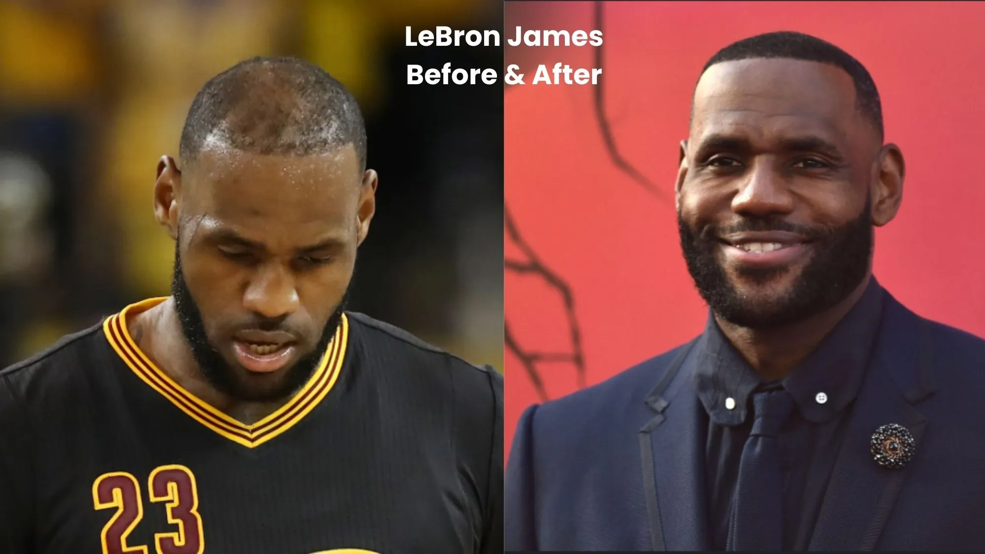 LeBron James hair transplant