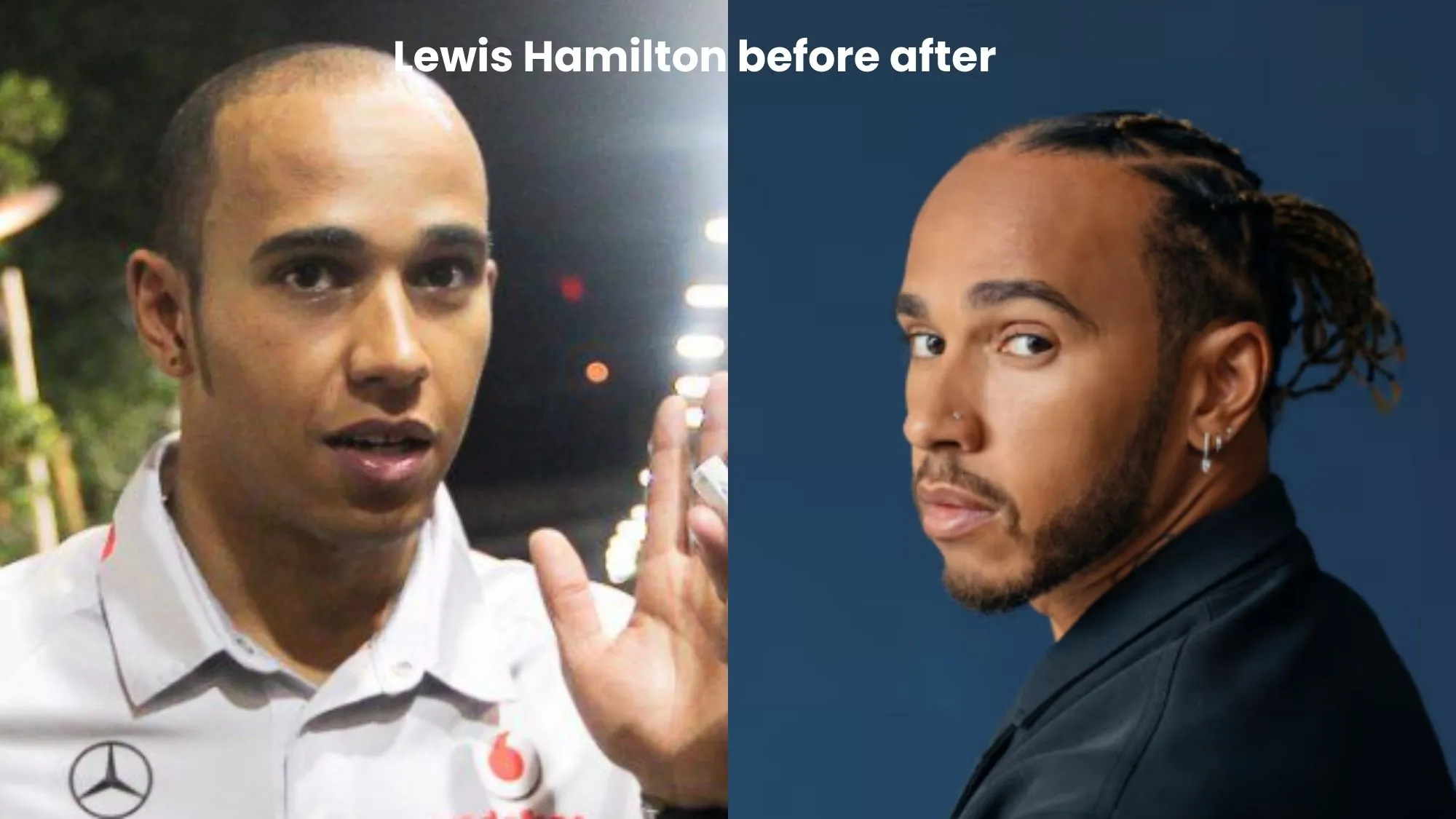 Lewis Hamilton hair transplant