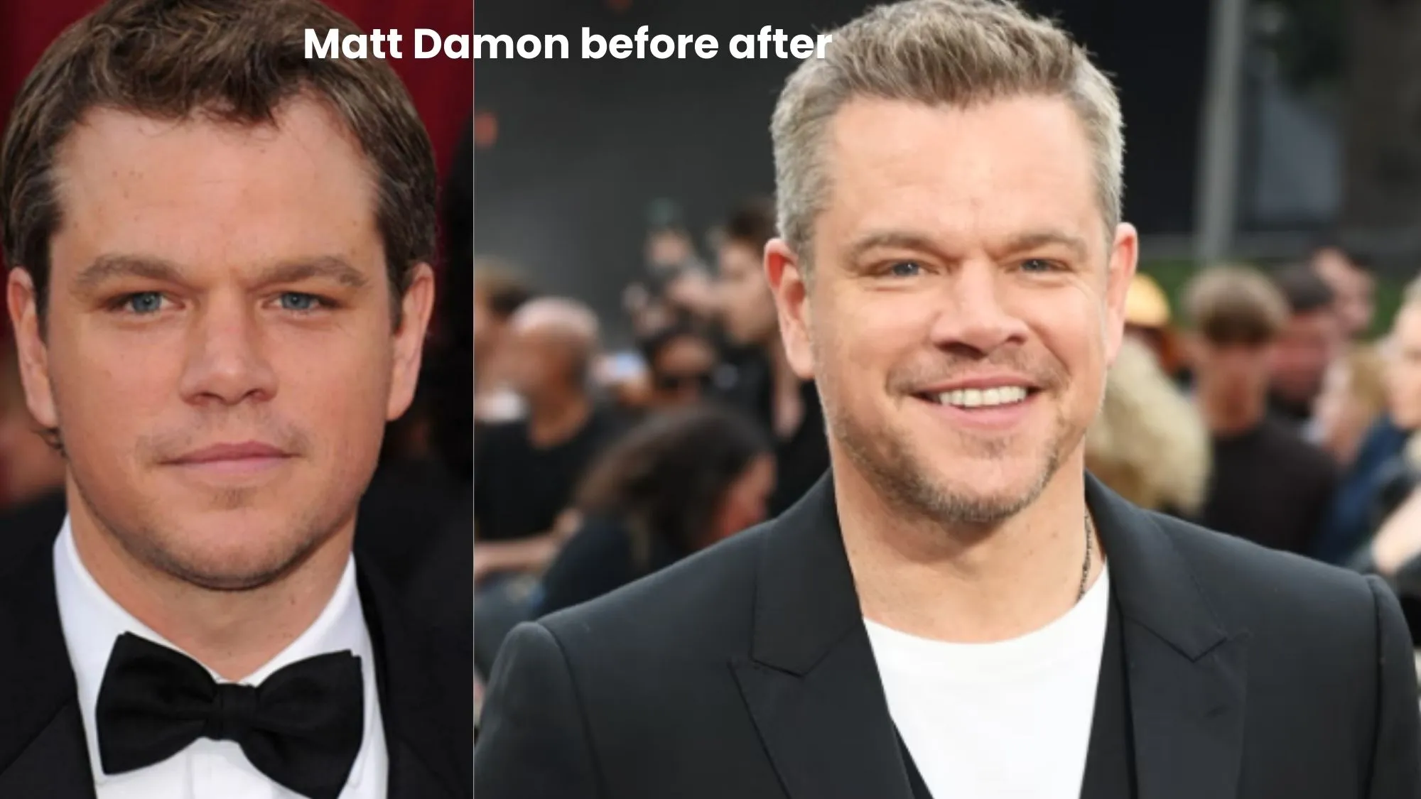 Matt Damon hair transplant